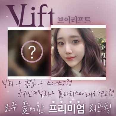브이리프트 플친 이벤트 — 박리 + 흡입 + 스마스고정, 유지인대박리 + 플라티스마내시경고정 모두 들어간 프리미엄 리프팅